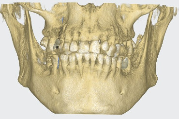 3D röntgen kép