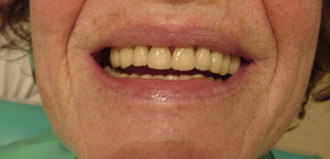Fémmentes cirkónium fogpótlás a teljes alsó és felső fogsorra