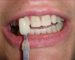 ZOOM2 professzionális fogorvosi fogfehérítés utána